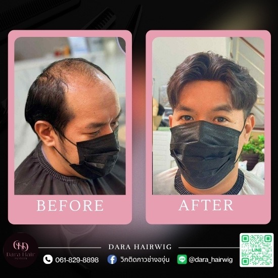 วิกติดกาว ราคา - ร้านวิกผมติดกาวผู้ชาย ช่างองุ่น - Dara Hairwig