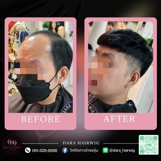 วิกผมปิดหัวล้าน