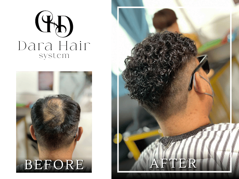 ร้านแก้ไขปัญหาศีรษะล้าน